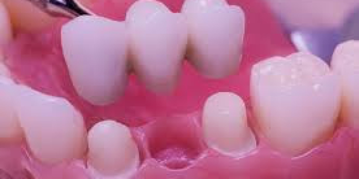 Common Types of Dental Bridges and Their Benefits