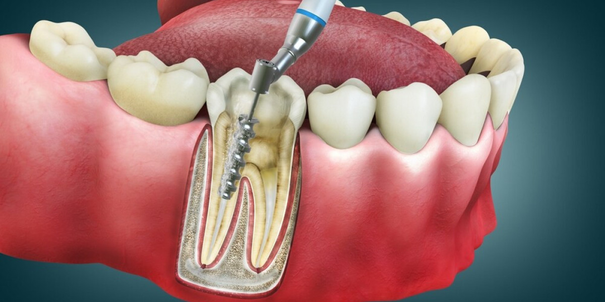 Root Canal vs. Extraction: Which Option Is Best?